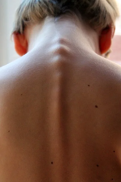 Dos d'un patient avant une séance d'ostéopathie